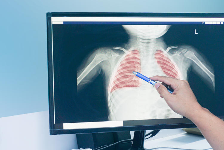 close up doctors in protective clothing discussing an x-ray a child of the lungs Respiratory Syncytial Virus on LCD monitor .