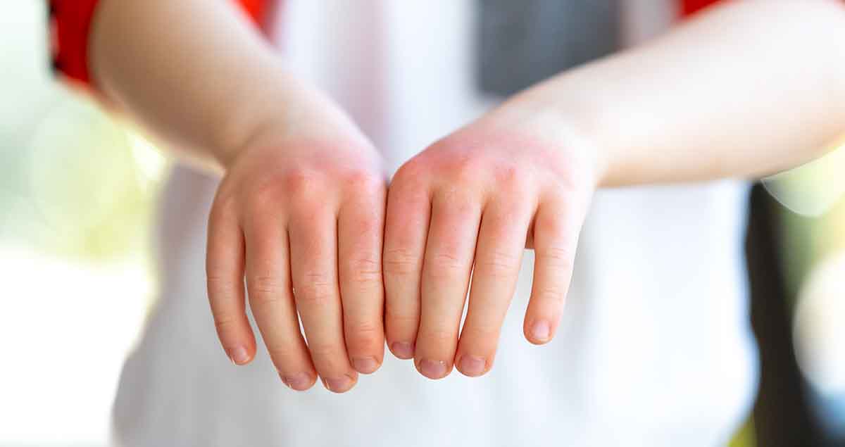 Photo of young boys hands covered with a red rash