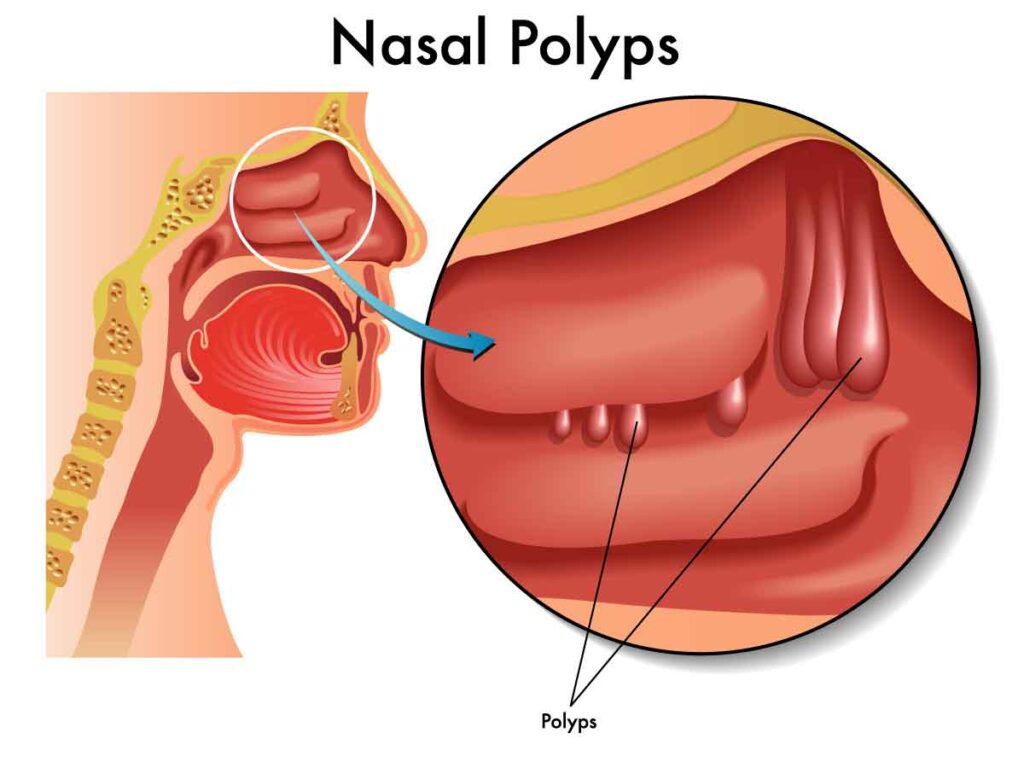 Infographic showing the a bisection of the face with the nasal cavity zoomed in to show nasal polyps.