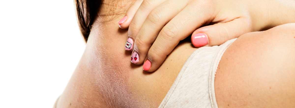 Woman scratching her back because of hives. She has aquagenic urticaria, a rare hive disease.