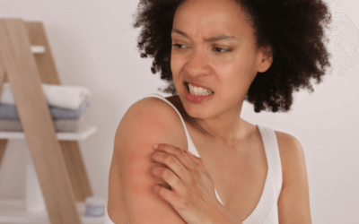 New Atopic Dermatitis Research Study