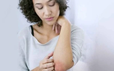 What’s Causing My Eczema? 6 Common Triggers
